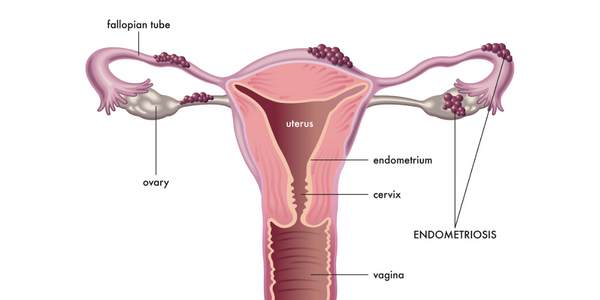 Endometriosis Treatment in Chennai